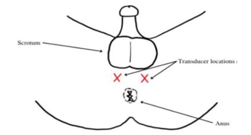 Aplicación bilateral (2 zonas)